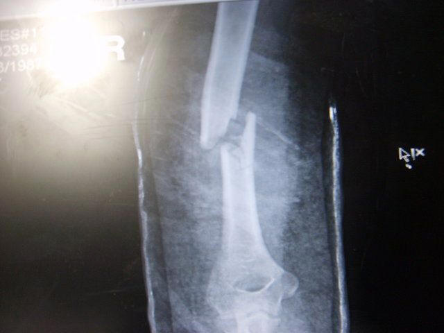 Botbreuk als vergelijking met de ruimte die zal ontstaan tussen de 1e en 2e hemel