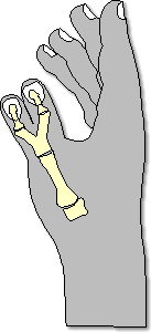 De extra duim werd verwijderd.